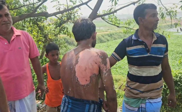 রূপগঞ্জে স্ত্রীর ছোড়া গরম ভাতের ফ্যানে  দগ্ধ স্বামী