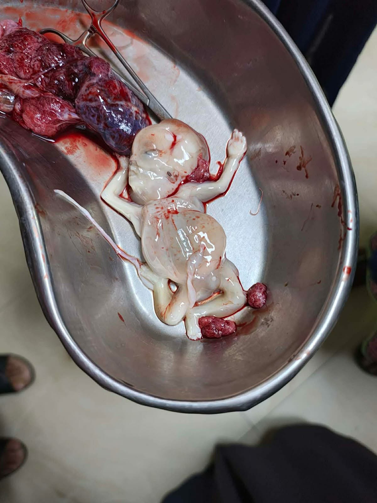 রূপগঞ্জে পেটে লাথি মেরে গর্ভের  সন্তান হত্যার অভিযোগ